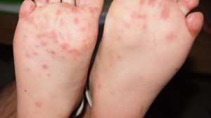 hand_foot_and_mouth_disease_on_child_feet